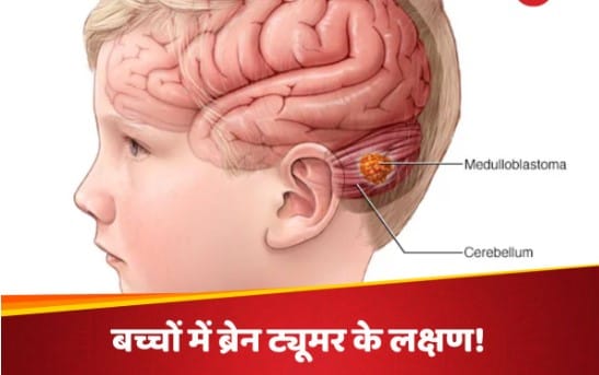 बच्चों को भी हो सकता है ब्रेन ट्यूमर, माता-पिता इन लक्षणों की ना करें अनदेखी ˌ बच्चों को भी हो सकता है ब्रेन ट्यूमर, माता-पिता इन लक्षणों की ना करें अनदेखी ˌ
