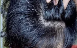 White Hair: बच्चों के बाल सफेद होने की वजह क्या है? जानिए इससे पचने के उपाय