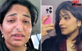 न दवा, न क्रीम; दुबई की लड़की ने ऐसे जड़ से खत्म किए मुहासे! Acne Transformation वीडियो हुआ वायरल