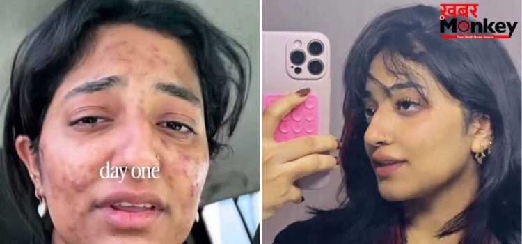 न दवा, न क्रीम; दुबई की लड़की ने ऐसे जड़ से खत्म किए मुहासे! Acne Transformation वीडियो हुआ वायरल
