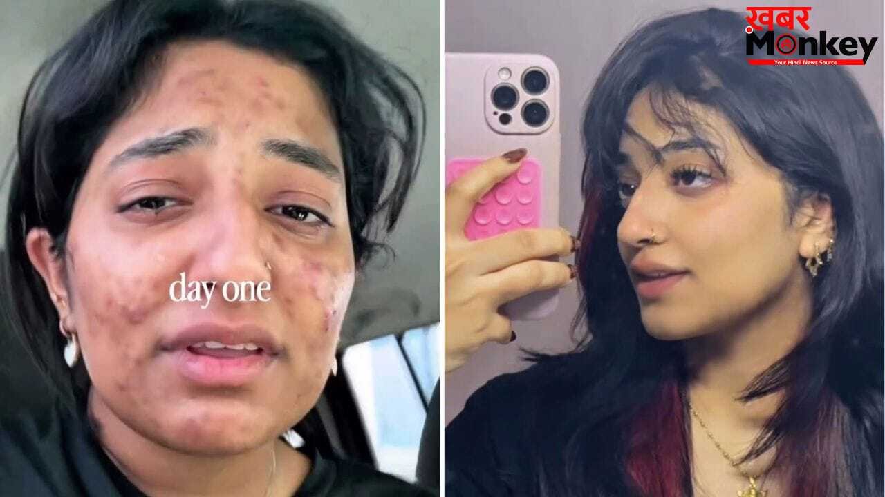 न दवा, न क्रीम; दुबई की लड़की ने ऐसे जड़ से खत्म किए मुहासे! Acne Transformation वीडियो हुआ वायरल