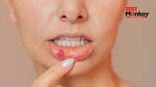 मुंह में छाले क्यों होते हैं? जानें इससे बचाव के आसान घरेलू उपाय