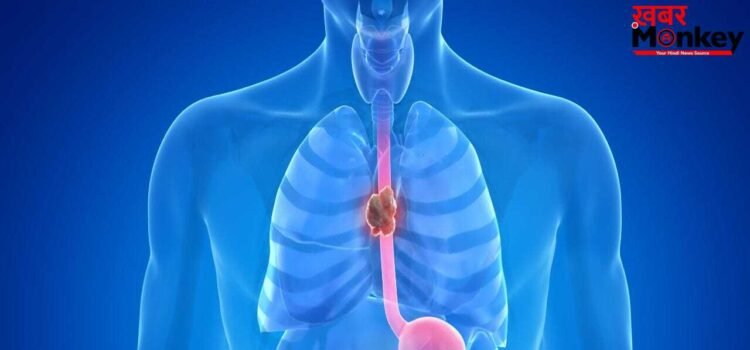 खाने की नली में भी हो सकता है कैंसर, ये लक्षण दिखें तो हो जाएं सतर्क