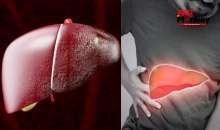 फैटी लिवर को हल्के में न लें, धीरे-धीरे बढ़ता है लिवर सिरोसिस का खतरा, ट्रांसप्लाट के अलावा नहीं है स्थाई इलाज