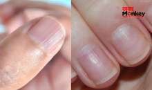 नाखून पर उभरी धारियां किस बात का संकेत है, क्यों बन जाती हैं लाइन, जानिए शरीर में किस कमी के कारण ऐसा होता है