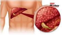World Liver Day: किस-किस कारण से खराब हो सकता है लिवर, किन लक्षणों को देखते ही हो जाना चाहिए सावधान