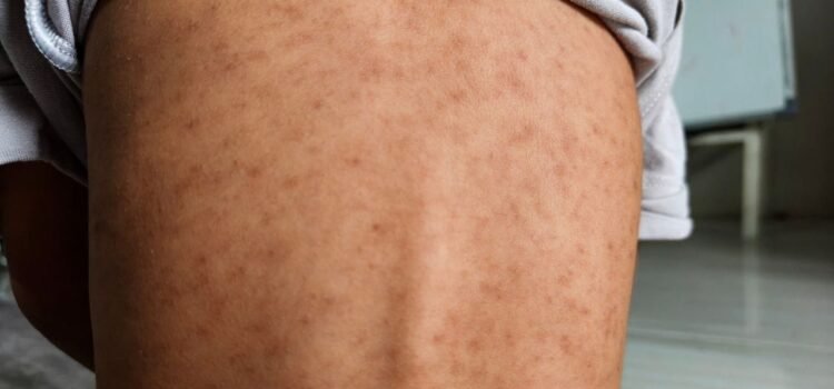 चेन्नई में खसरा के मामले बढ़े, जानें कारण, लक्षण और बचाव