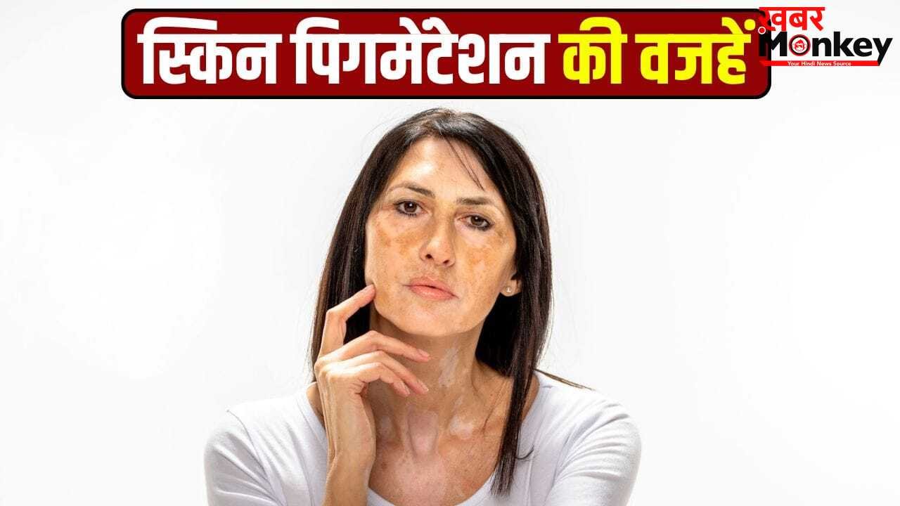 स्किन पिगमेंटेशन के क्या कारण हैं? इससे कैसे बचें