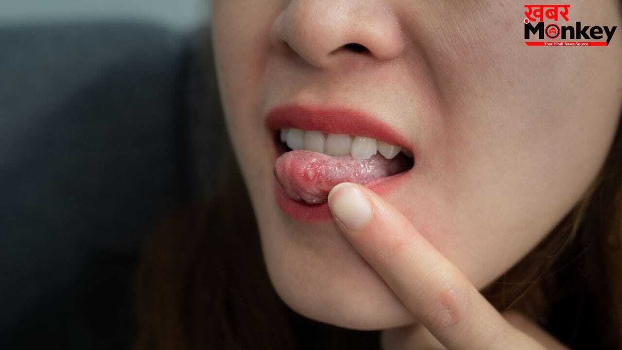 जीभ पर छाले क्यों होते हैं? क्या ये कोई खतरनाक बीमारी है