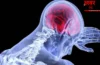 Dementia Disease: डिमेंशिया से पीड़ित थे मशहूर शायर डॉ. बशीर बद्र, जानिए कितनी खतरनाक है यह बीमारी