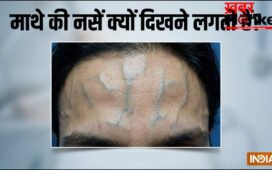 माथे की नसें क्यों दिखने लगती हैं, नस फड़कने पर क्या करें, जानिए इसके कारण और ठीक करने के उपाय