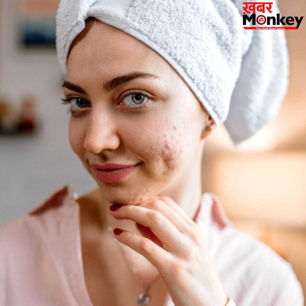 Pimples-Acne Problem: चेहरे पर एक्ने-पिंपल्स का खतरा बढ़ाती हैं ये खाने की चीजें, आज ही बनाएं दूरी