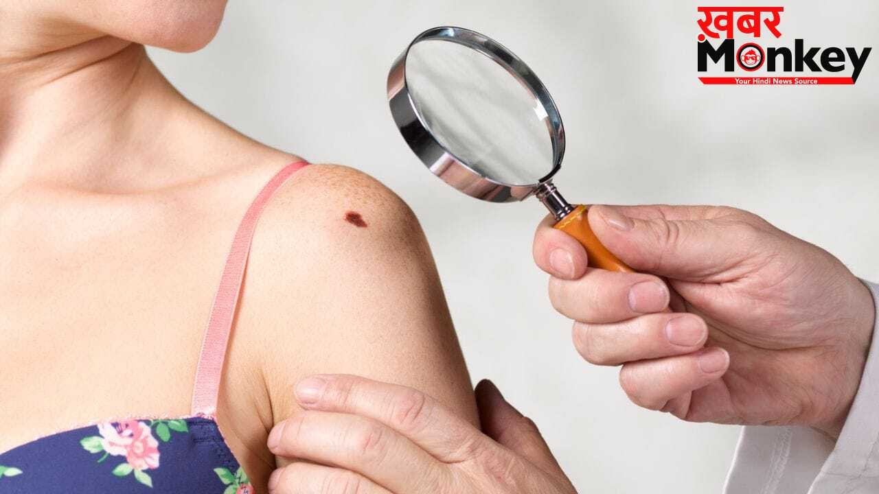 शरीर पर मौजूद तिल सुरक्षित है या सेहत के लिए खतरनाक? ऐसे करें पहचान