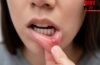 Mouth Cancer Symptoms: लंबे समय तक ठीक नहीं हो रहे छाले हो सकते हैं मुंह के कैंसर के संकेत, जानिए विशेषज्ञ क्या कहते हैं