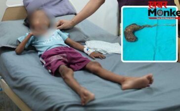 गोरखपुर में 7 साल की बच्ची के पेट से निकला बालों का गुच्छा, डॉक्टर भी रह गए हैरान; बाल खाने की आदत थी