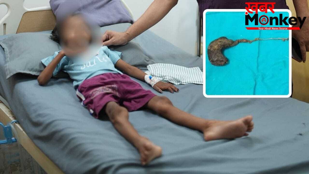 गोरखपुर में 7 साल की बच्ची के पेट से निकला बालों का गुच्छा, डॉक्टर भी रह गए हैरान; बाल खाने की आदत थी